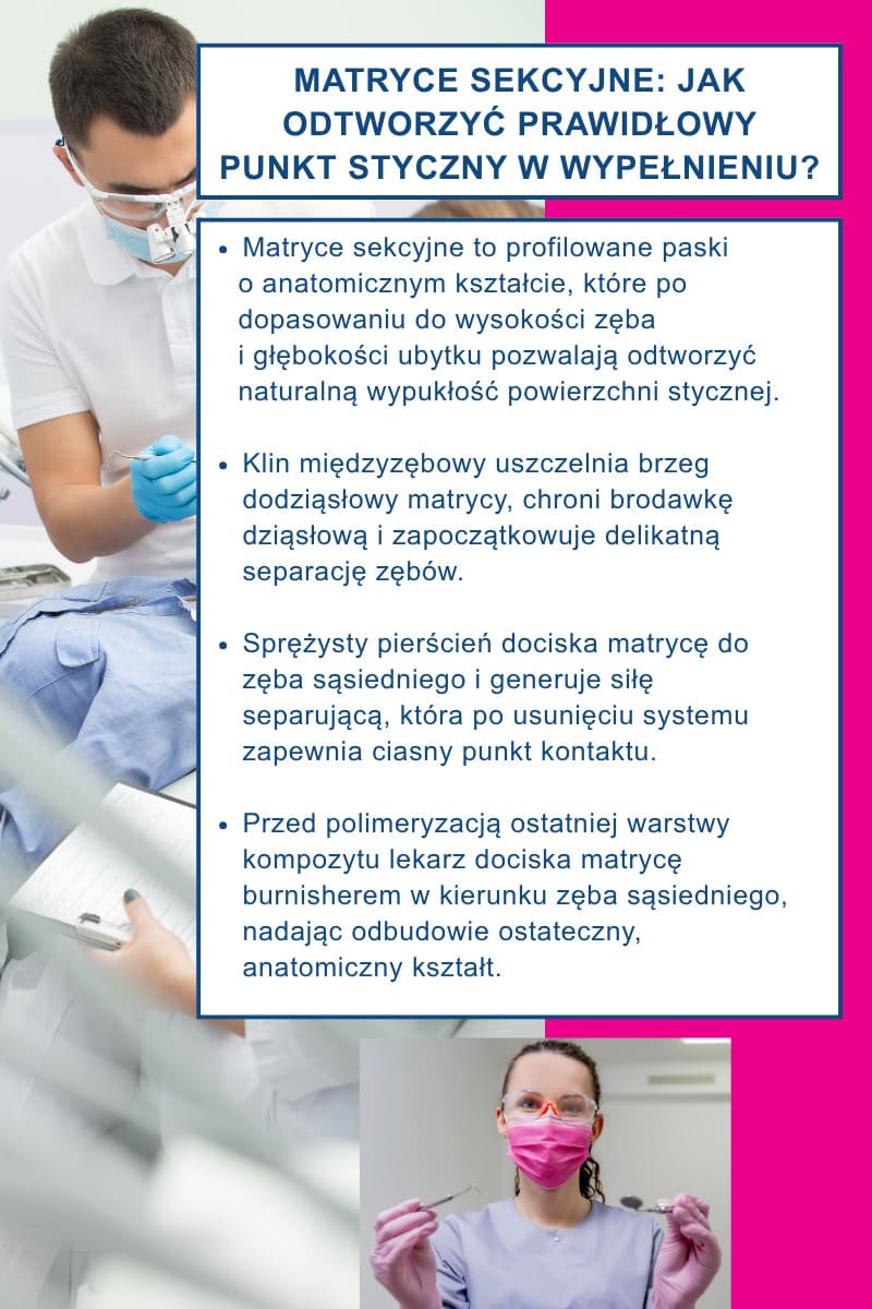 Matryce sekcyjne: jak odtworzyć prawidłowy punkt styczny w wypełnieniu?